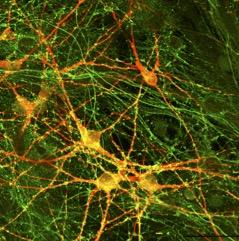 A neuron derived from a patient.